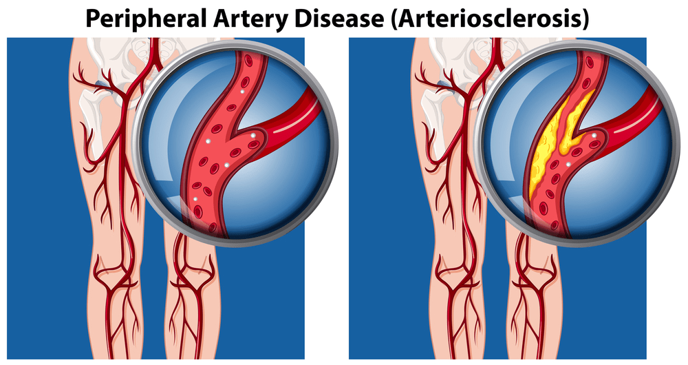 How Can You Treat Peripheral Arterial Disease?