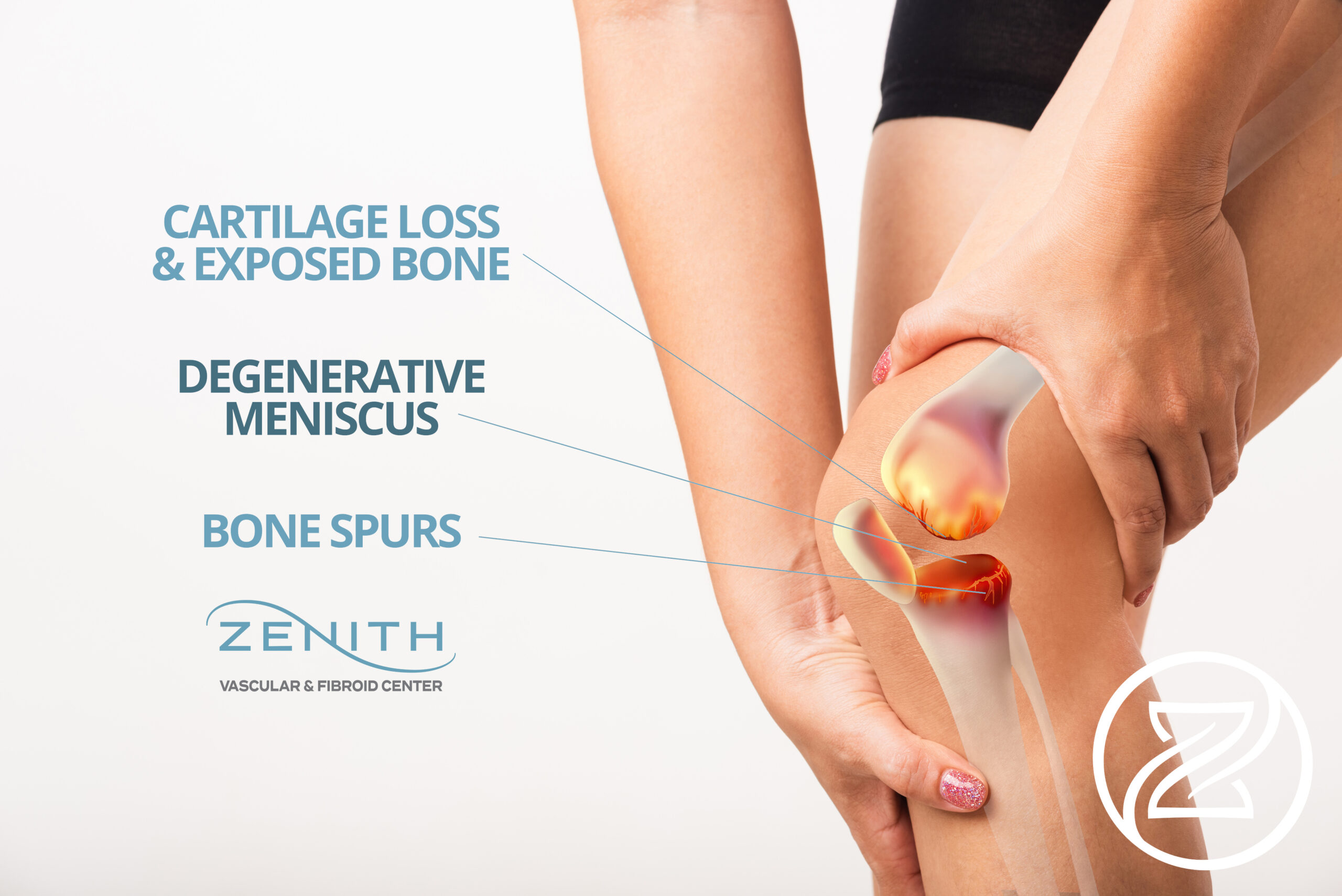 cartilage loss and exposed bone, degenerative meniscus, bone spurs