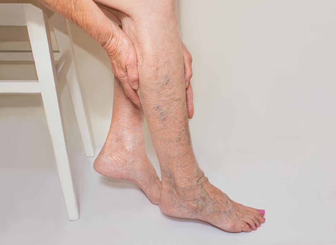 how can you treat peripheral arterial disease