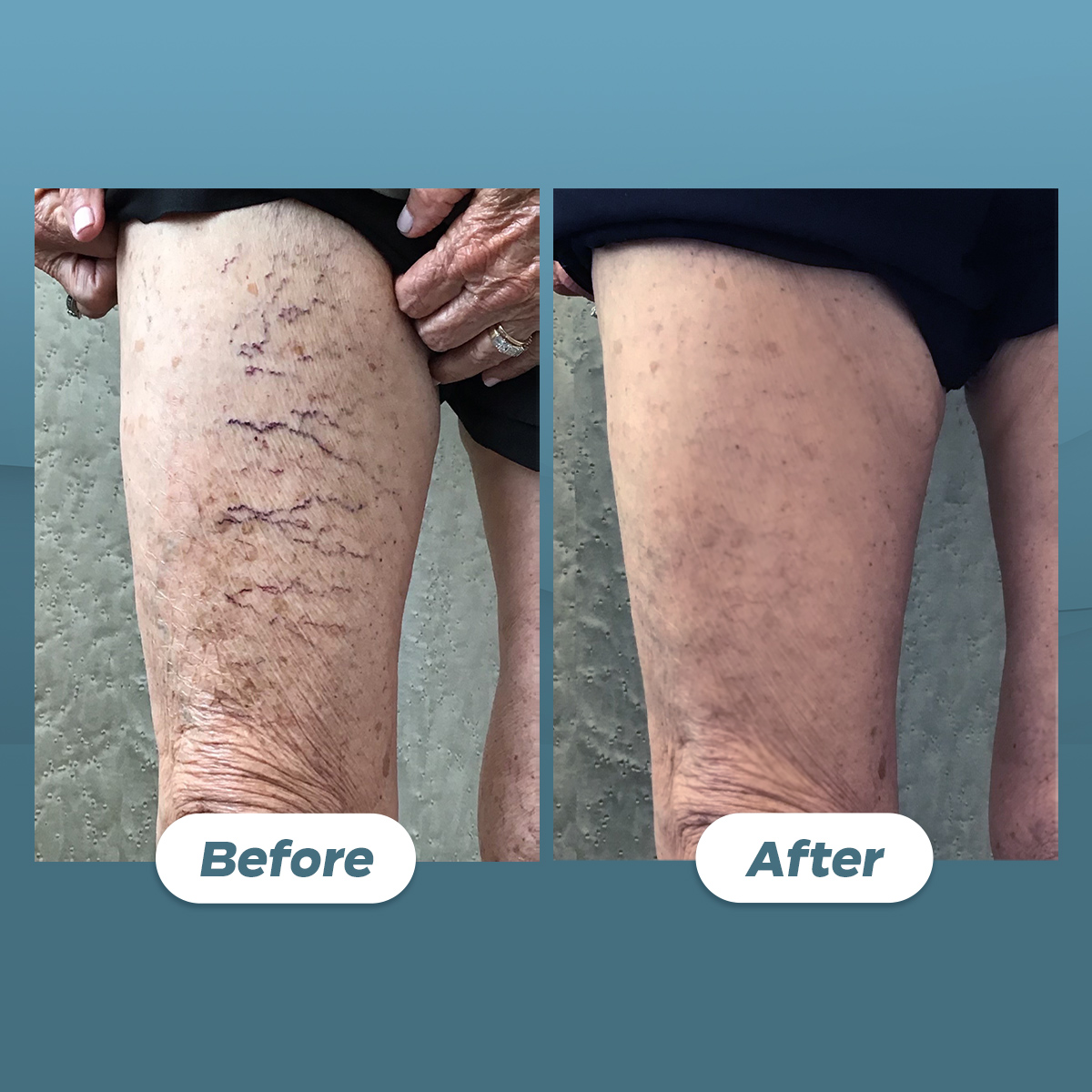 before and after Sclerotherapy vein treatment