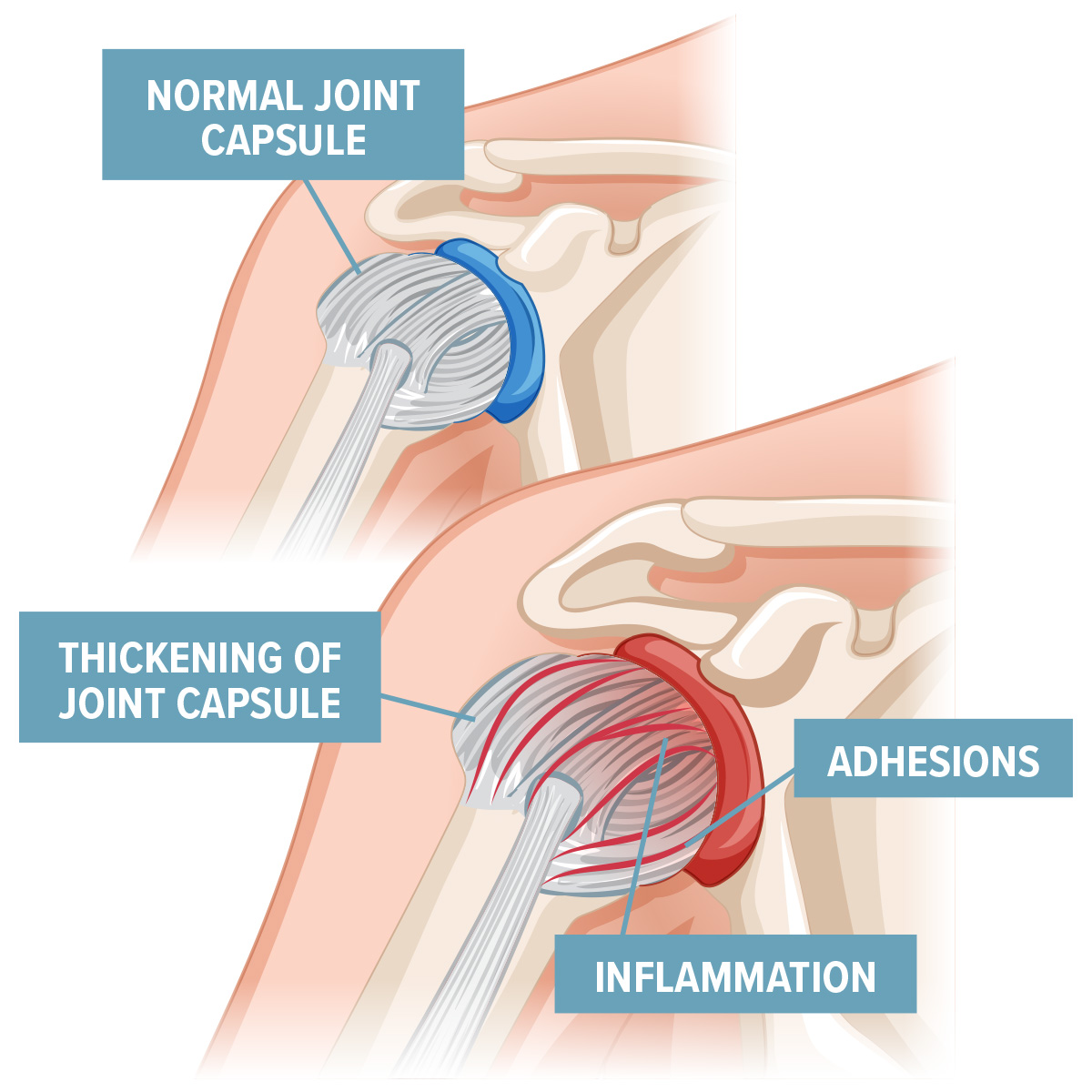 frozen shoulder pain